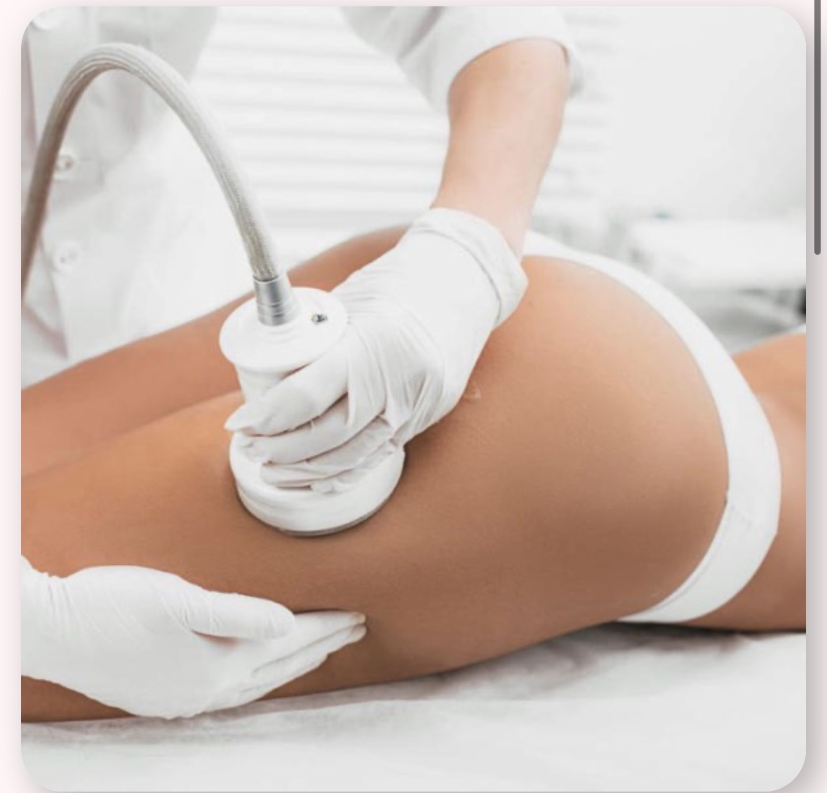 Lipocavitation et radiofréquence